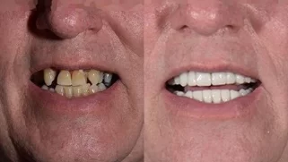 x-dentistry-restorative dentistry before after patient 10