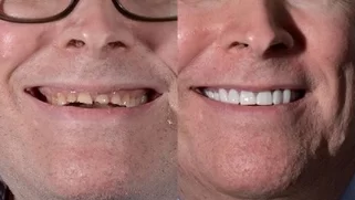 x-dentistry-restorative dentistry before after patient 11