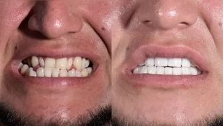 x-dentistry-restorative dentistry before after patient 12