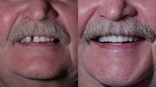 x-dentistry-restorative dentistry before after patient 15