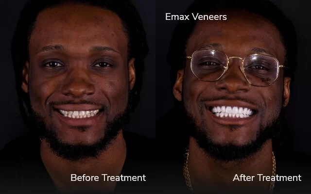before and after veneers 2