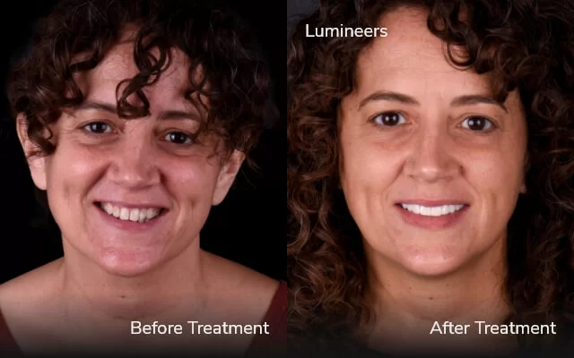 before and after veneers 3