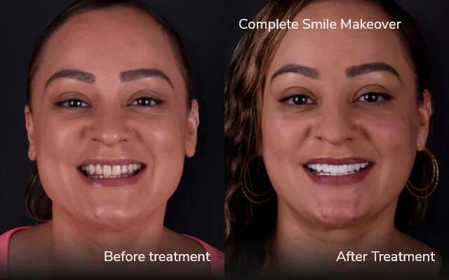 before and after veneers 1