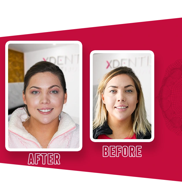 dental veneers smiling patient tijuana x dentistry