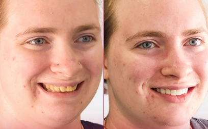 Porcelain Veneers Cost in Mexico