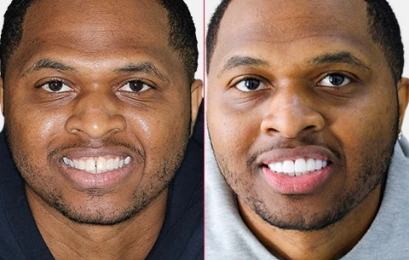 Porcelain Veneers Cost in Mexico