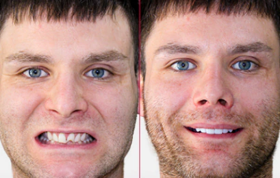 smile makeover dental veneers tijuana