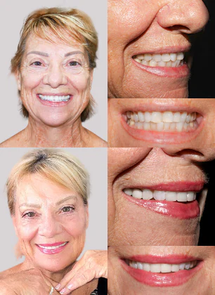 smile makeover mexico