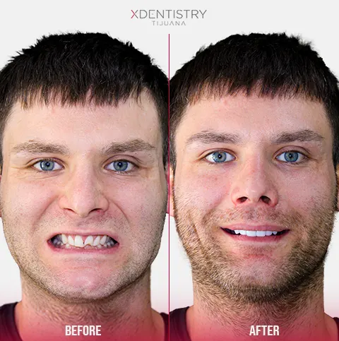 all on 4 patient xdentistry tijuana 04