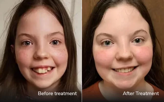 before after invisalign tijuana cost 01
