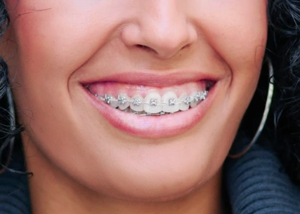 ceramic braces tijuana