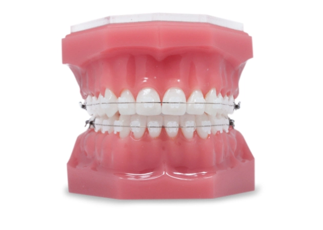 Ceramic Braces Tijuana