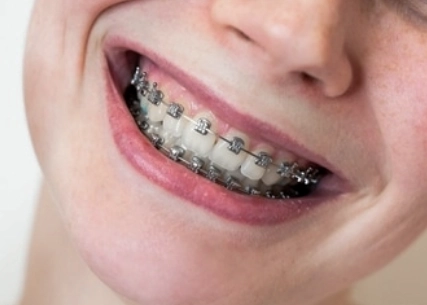 metal braces tijuana