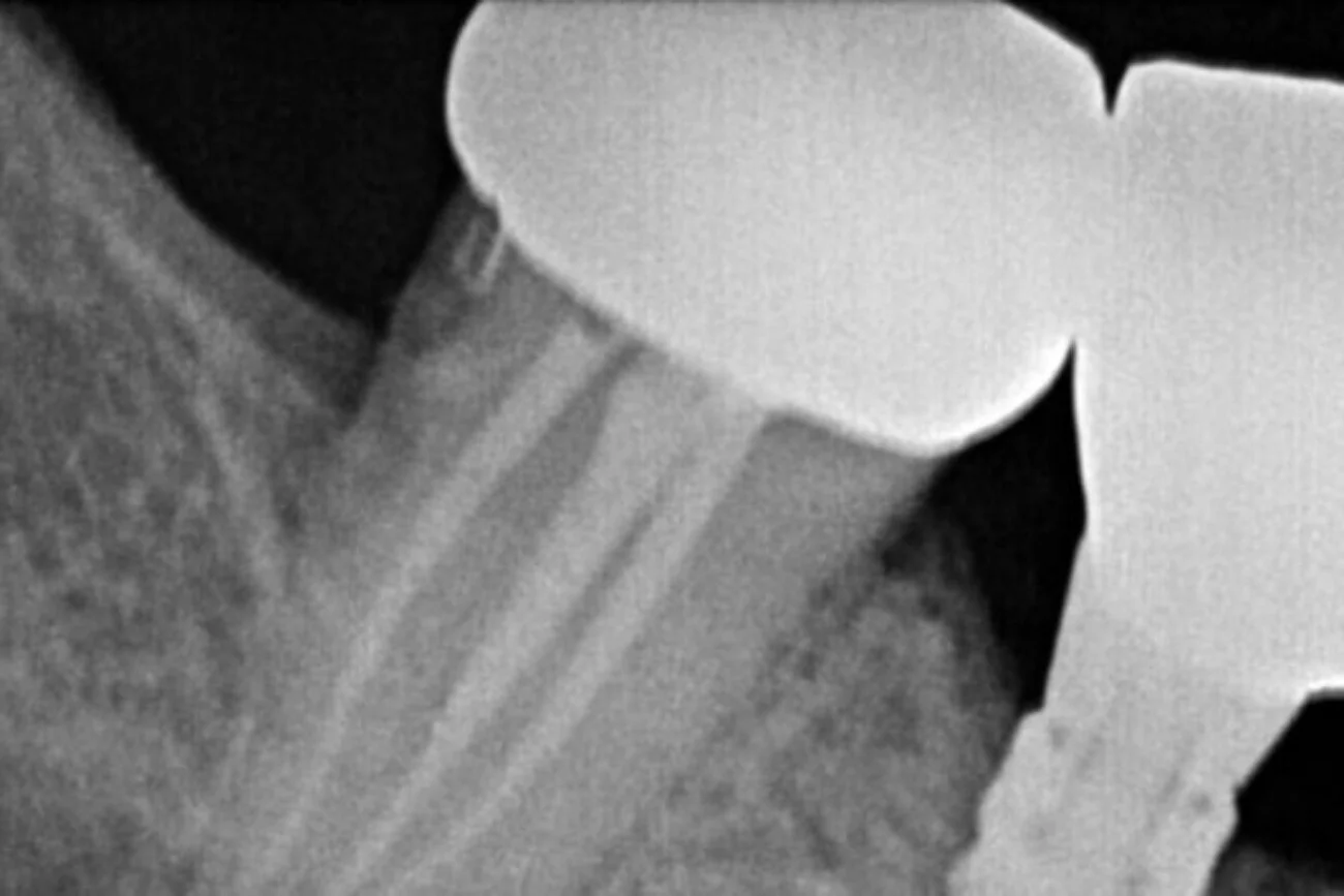 x dentistry root canal crown over root slider 02 01
