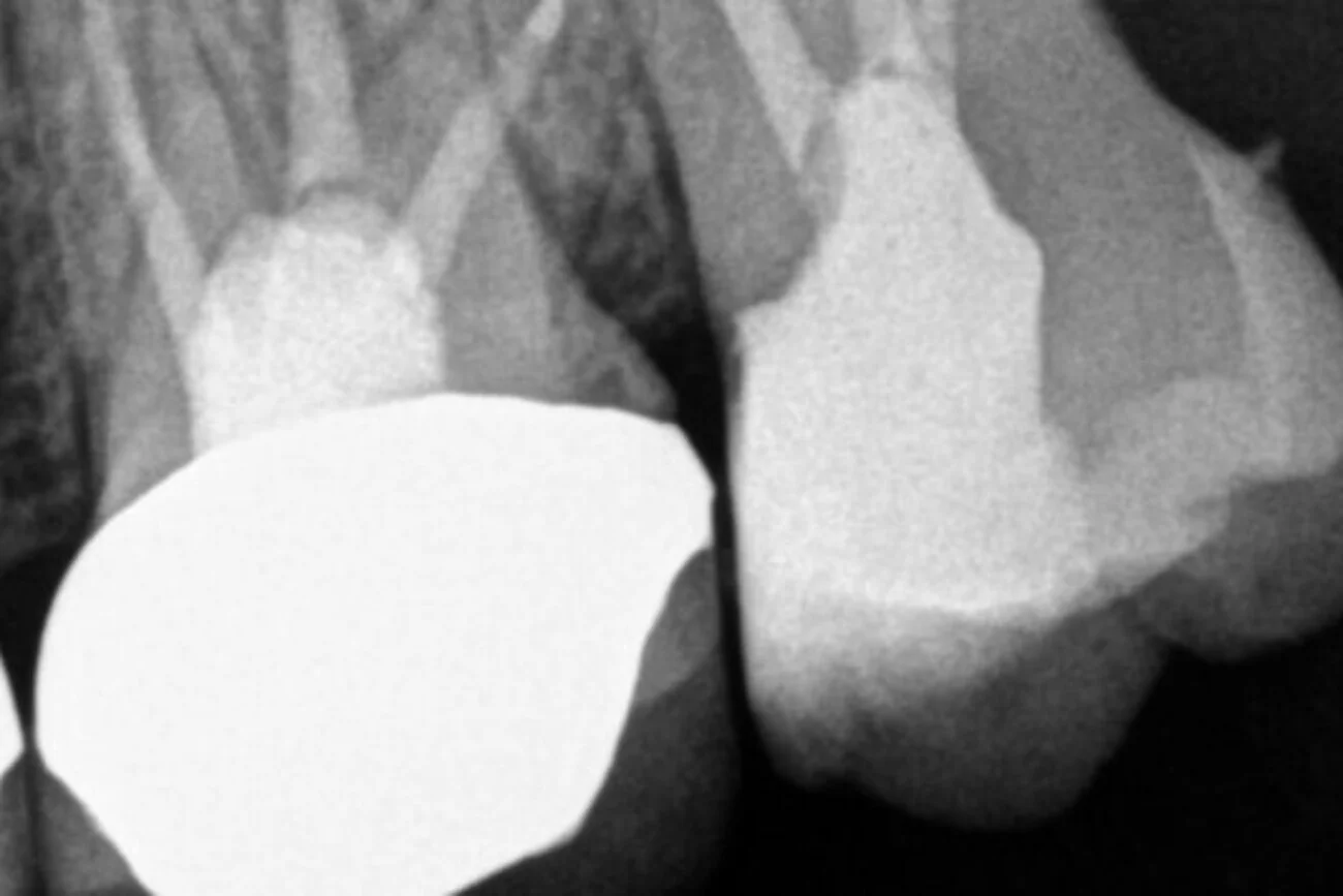 x dentistry root canal crown over root slider 02 02
