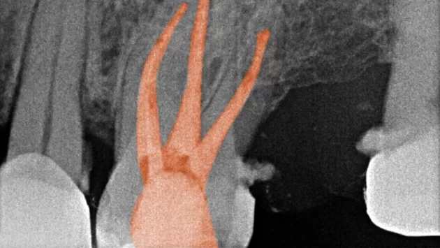x dentistry root canal root marked slider 01