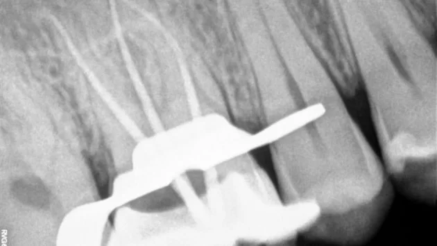 x dentistry root canal root marked slider 03