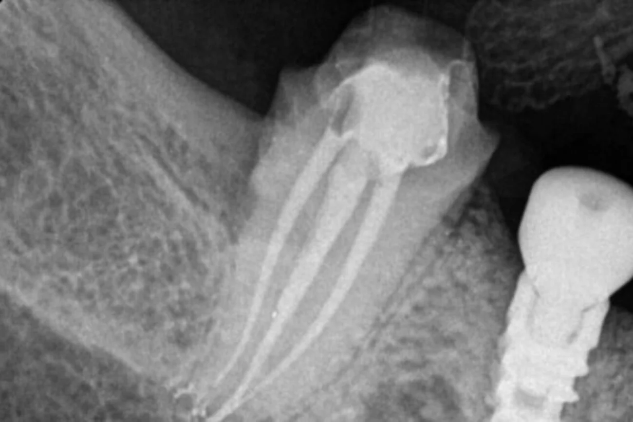 x dentistry root canal slider 02 03