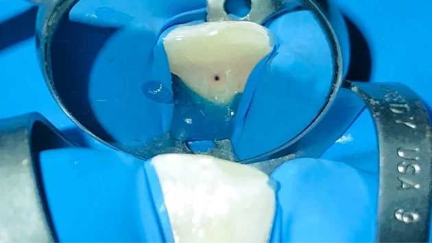 x dentistry root canal root marked slider 02