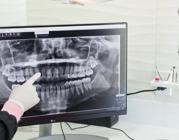Dental Implants 