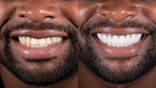 x dentistry smile makeover before after 04