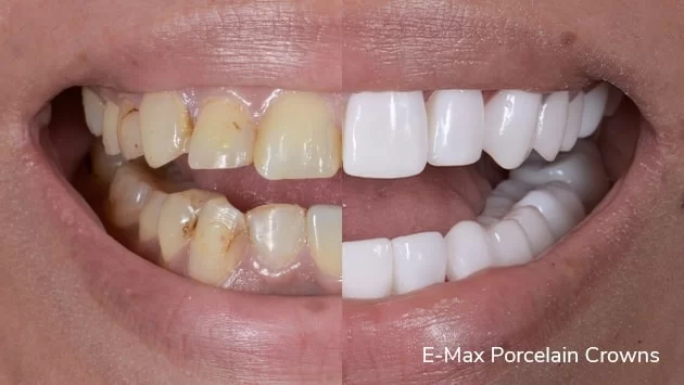 x dentistry veneers before after 02