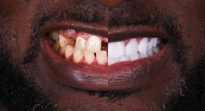 x dentistry full mouth reconstruction before after 01