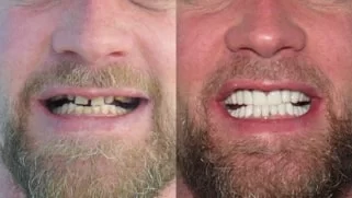 x dentistry smile makeover before after 05