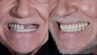 x dentistry full mouth reconstruction before after 06