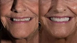 x dentistry full mouth reconstruction before after 07