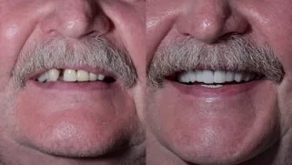 x dentistry full mouth reconstruction before after 08