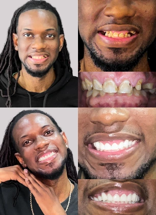 x dentistry smile makeover veneers patient