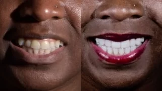 x dentistry smile makeover before after 01