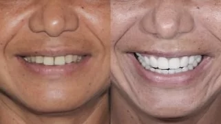x dentistry smile makeover before after 03