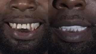 x dentistry smile makeover before after 04