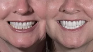 x dentistry smile makeover before after 05