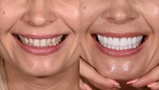 x dentistry smile makeover before after 07