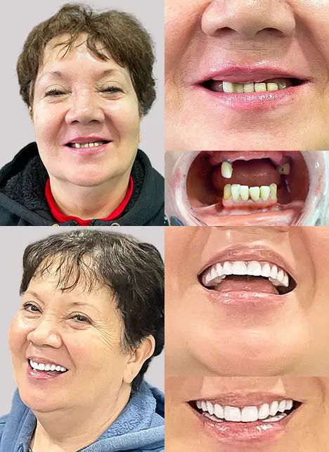 x dentistry snap on dentures patient in lobby 1