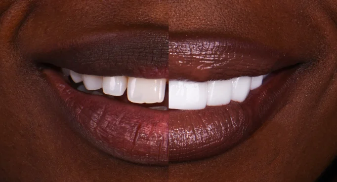 x dentistry snap on denture patient before after 01