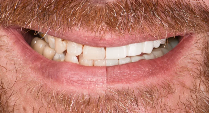 x dentistry snap on denture patient before after 02