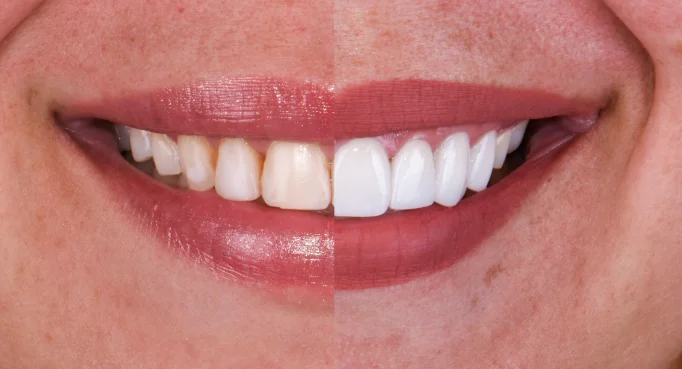 x dentistry snap on denture patient before after 03
