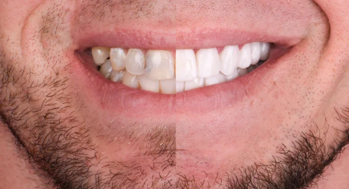 x dentistry snap on denture patient before after 08