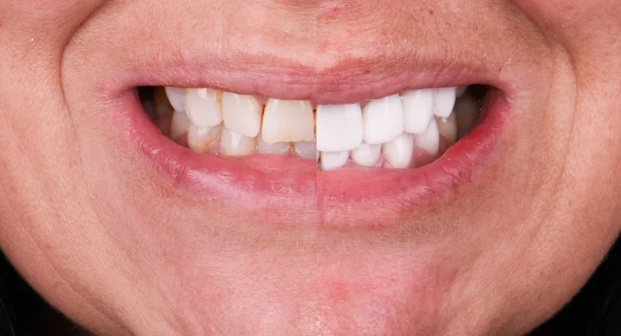 x dentistry snap on denture patient before after 07