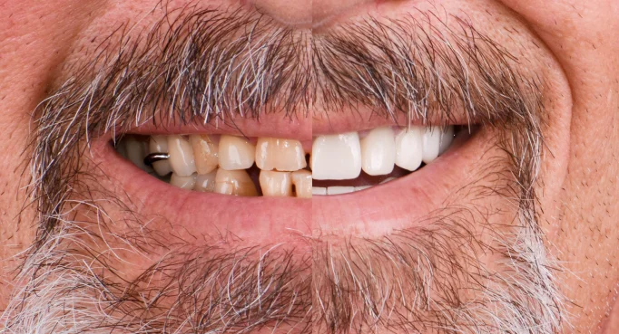 x dentistry snap on denture patient before after 06