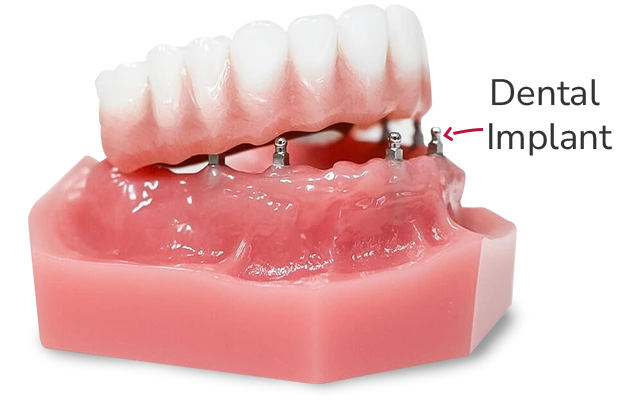 x dentistry snap on dentures laboratory