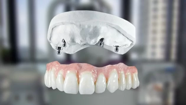 x dentistry snap on dentures ball abutment denture