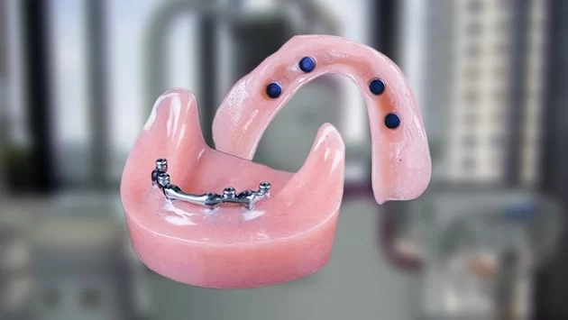 x dentistry snap on denture denture bar retained