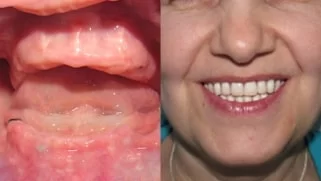 x dentistry snap on denture patient before after 01
