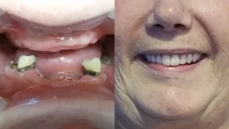 x dentistry snap on denture patient before after 02