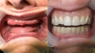 x dentistry snap on denture patient before after 04